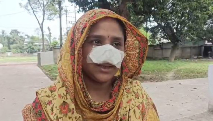 সুন্দর, তাই স্ত্রীর নাক কামড়ে নিলো স্বামী