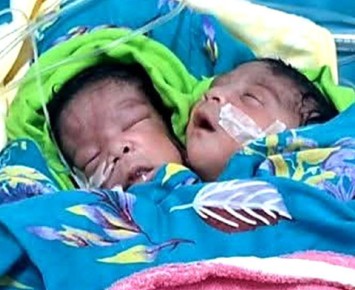 রাজশাহীতে জন্ম নিলো দুই মাথার শিশু